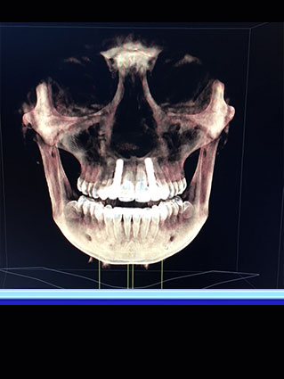 sirona galileos cbct