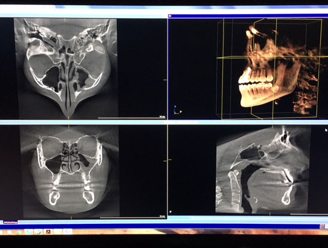 Sironos scan